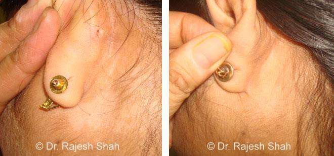 Vitiligo Before and After Case Photo