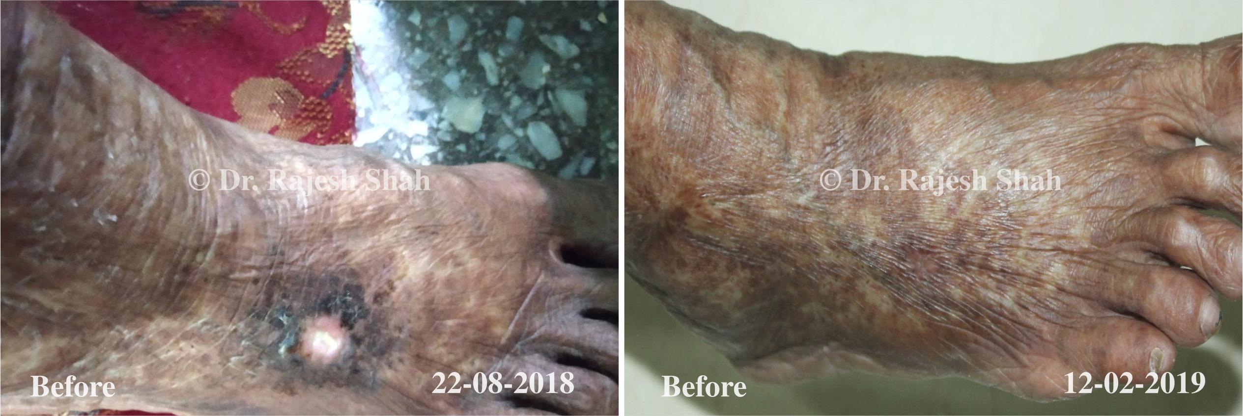 ulcer Before and After Case Photo