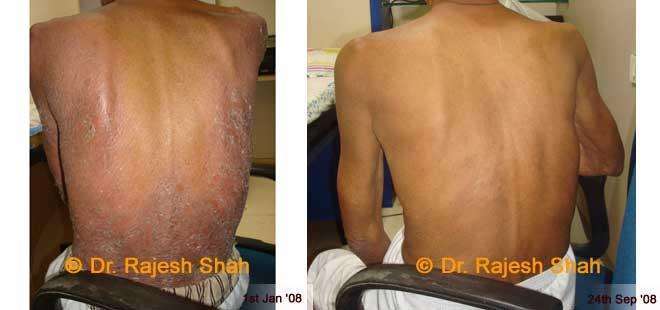 Psoriasis Before and After Case Photo