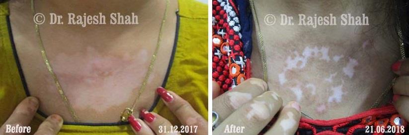 Vitiligo Before and After Case Photo