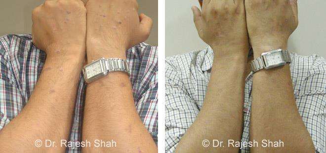 Lichen Planus Before and After Case Photo