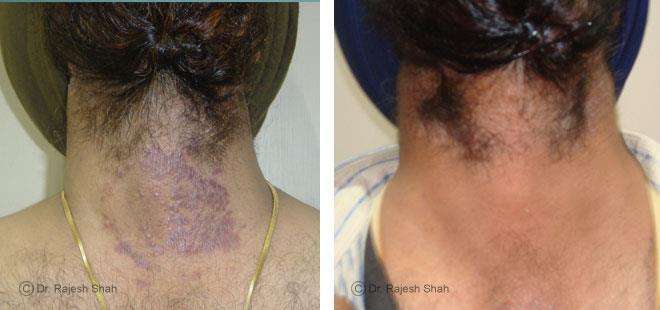 Psoriasis Before and After Case Photo