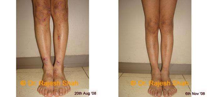 Eczema Before and After Case Photo