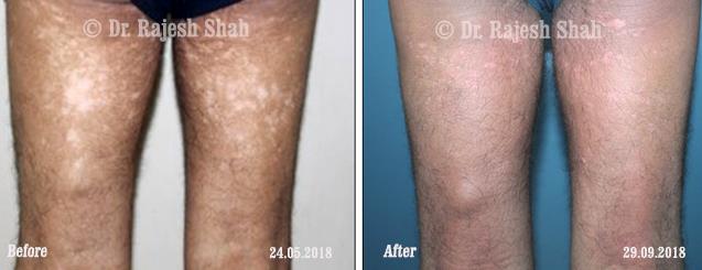 Vitiligo Before and After Case Photo