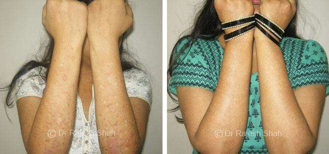 Psoriasis Before and After Case Photo