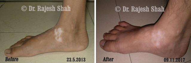 Vitiligo Before and After Case Photo