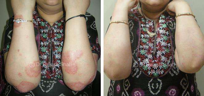 Psoriasis Before and After Case Photo