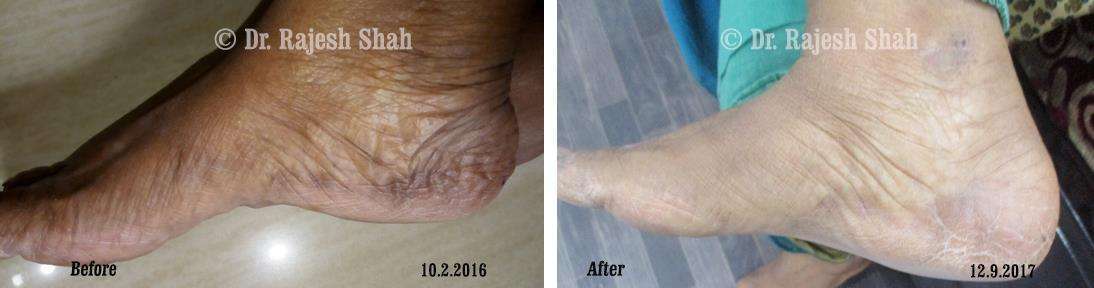 Hyperpigmentation Before and After Case Photo