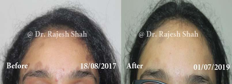 Lichen Planus Pigmentosa Before and After Case Photo