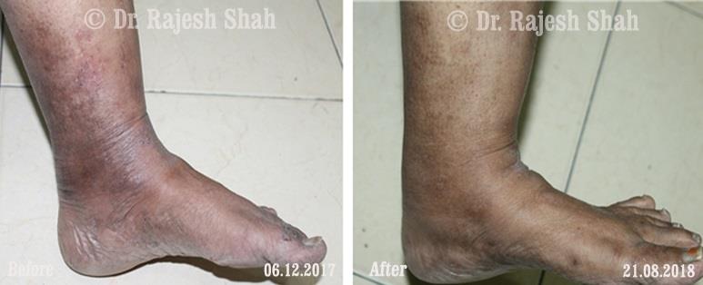 Atopic Dermatitis Before and After Case Photo