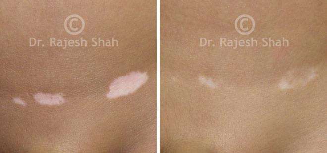 Vitiligo Before and After Case Photo