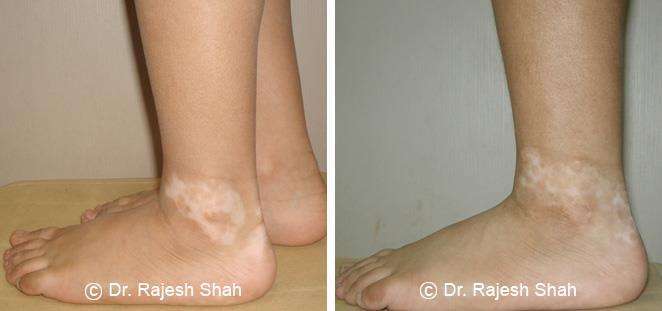 Vitiligo Before and After Case Photo