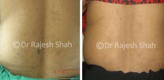 Lichen Planus Before and After Case Photo