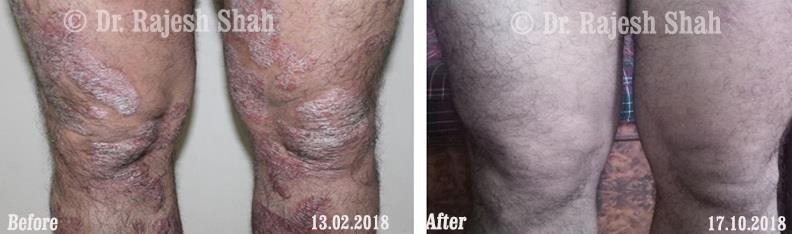 Psoriasis Before and After Case Photo