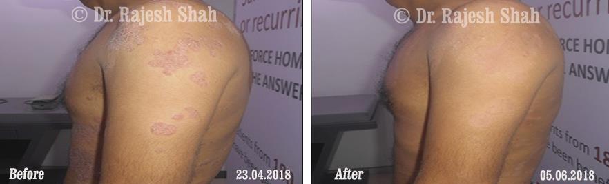 Psoriasis Before and After Case Photo