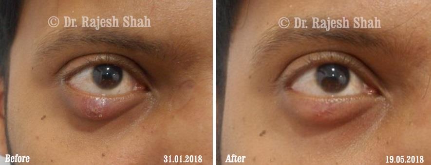 Chalazion Before and After Case Photo