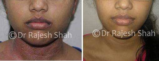 Eczema Before and After Case Photo