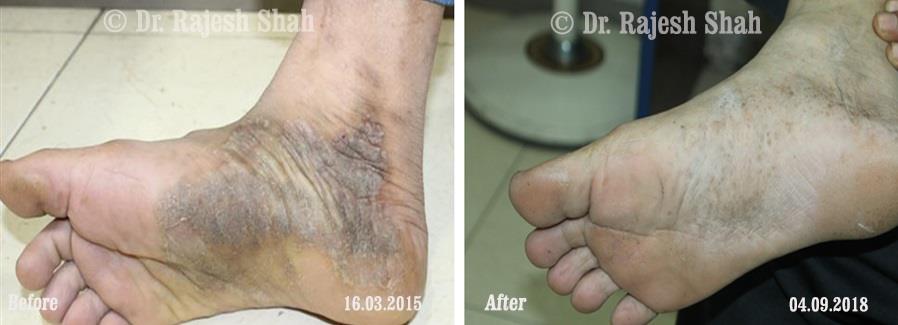 Psoriasis Before and After Case Photo