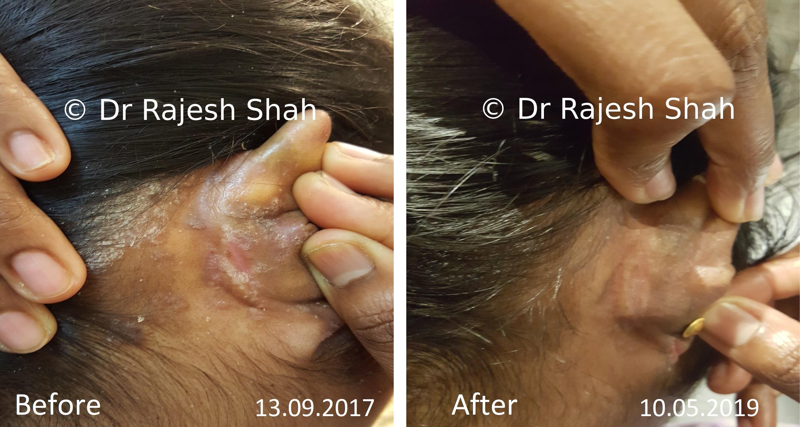 Psoriasis Before and After Case Photo