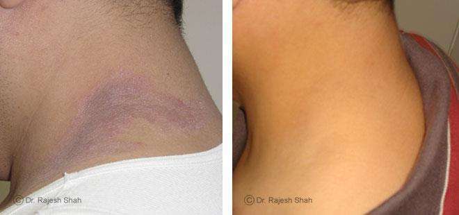 Eczema Before and After Case Photo