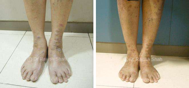 Lichen Planus Before and After Case Photo