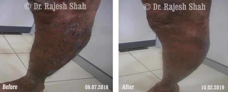 Psoriasis Before and After Case Photo