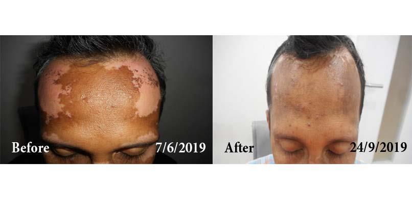 Vitiligo Before and After Case Photo