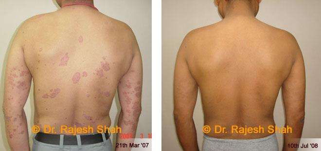Psoriasis Before and After Case Photo