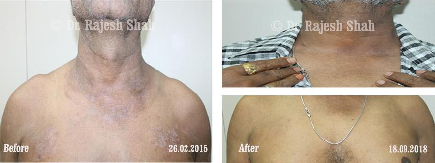 Psoriasis Before and After Case Photo