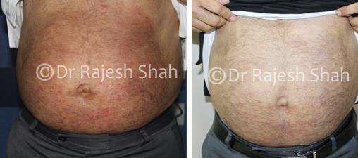 Eczema Before and After Case Photo