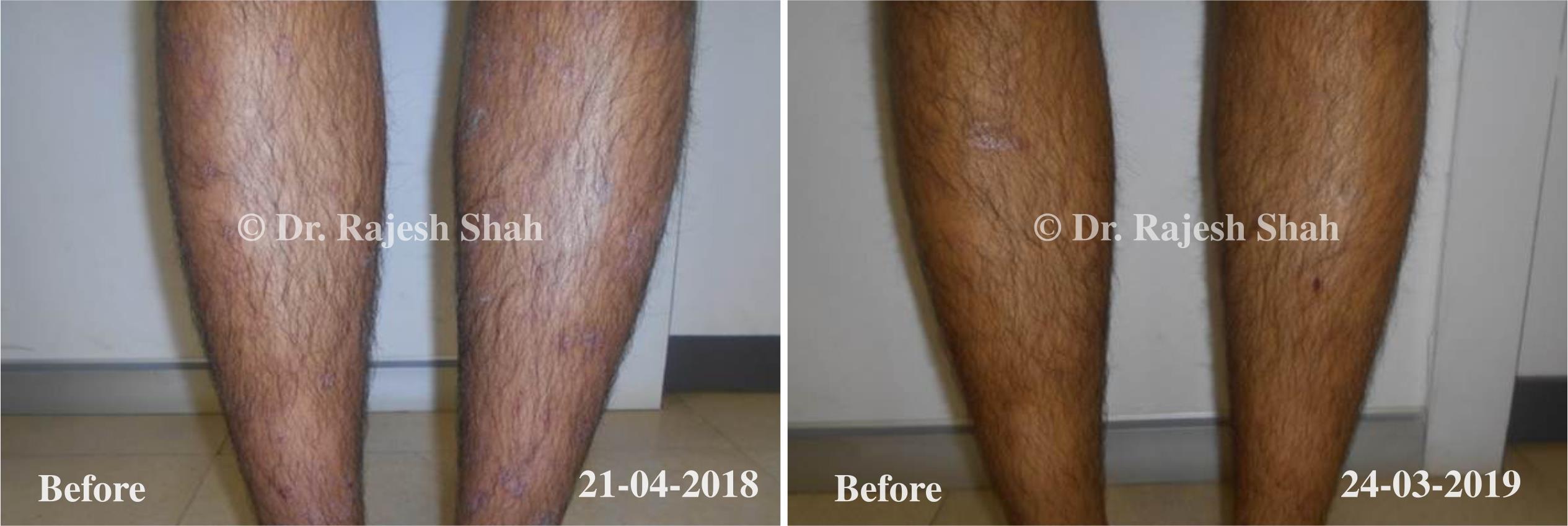 Psoriasis Before and After Case Photo