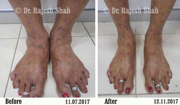 Lichen Planus Before and After Case Photo