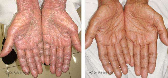 Psoriasis Before and After Case Photo