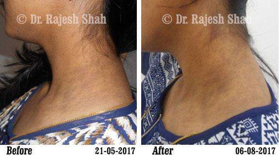 Lichen Planus Pigmentosa Before and After Case Photo