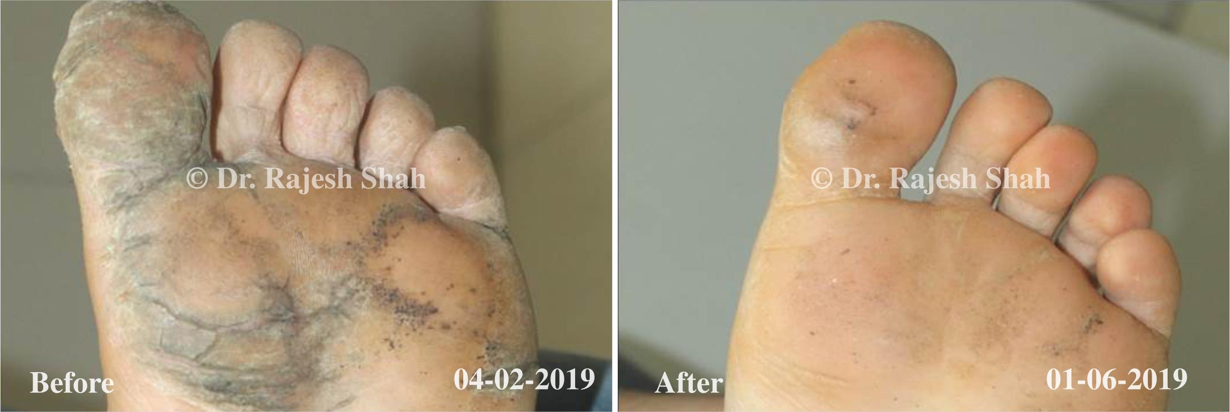 Psoriasis Before and After Case Photo
