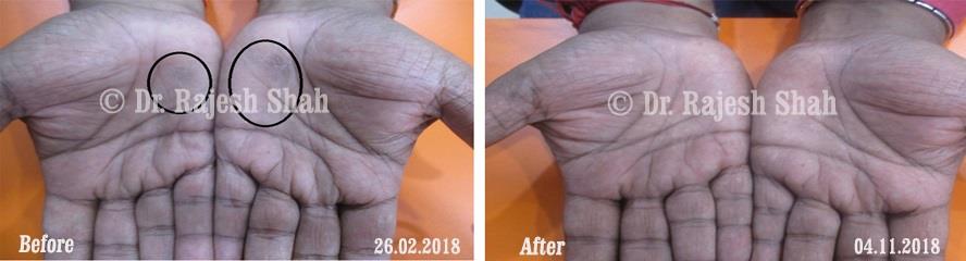 Psoriasis Before and After Case Photo