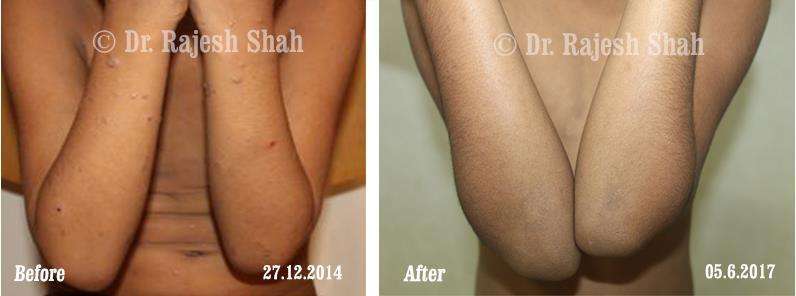 Lichen Planus Before and After Case Photo