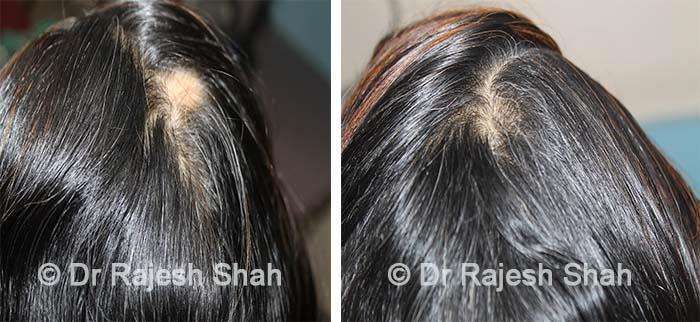 Alopecia Areata Before and After Case Photo