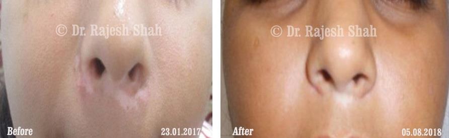 Vitiligo Before and After Case Photo