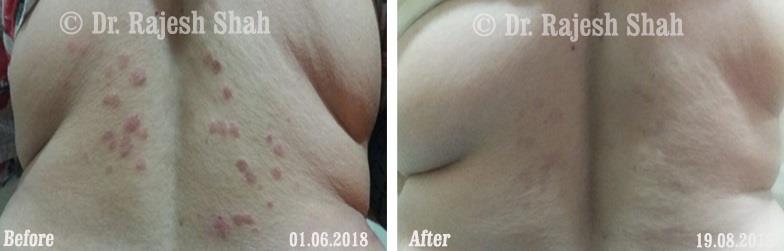 Psoriasis Before and After Case Photo