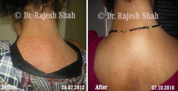 Granuloma Annulare Before and After Case Photo