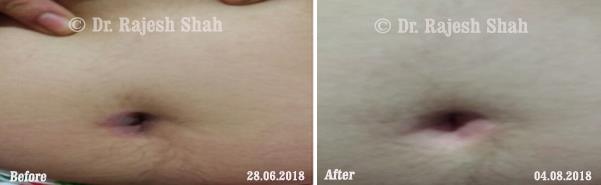 Psoriasis Before and After Case Photo