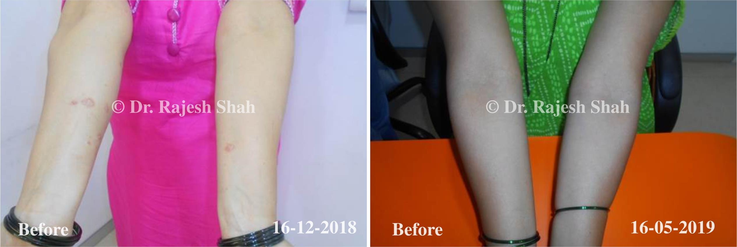 Psoriasis Before and After Case Photo