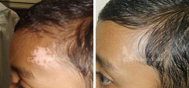 Vitiligo Before and After Case Photo
