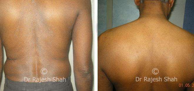 Psoriasis Before and After Case Photo