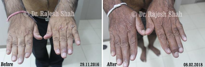 Psoriasis Before and After Case Photo