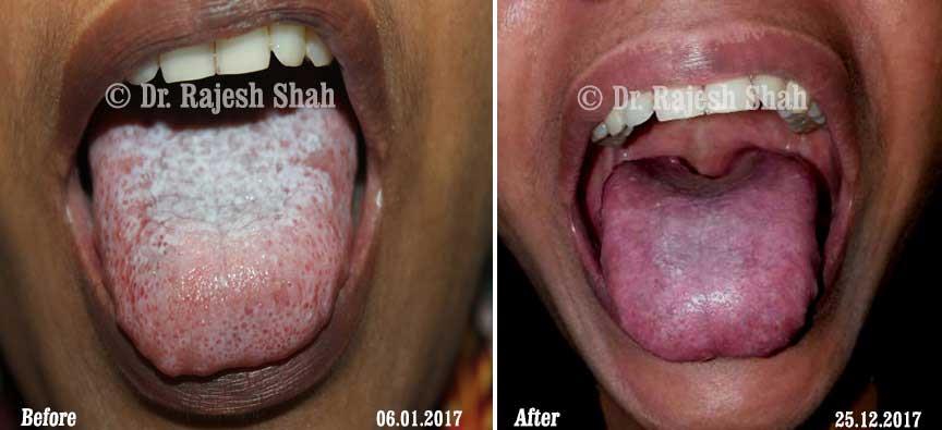 Lichen Planus Before and After Case Photo