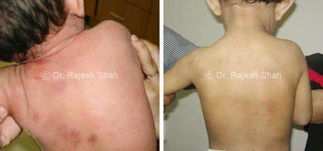 Atopic Dermatitis Before and After Case Photo
