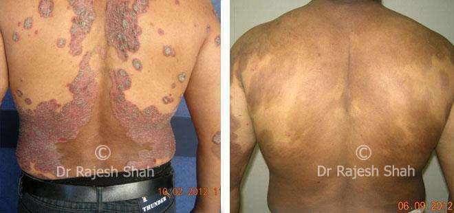 Psoriasis Before and After Case Photo