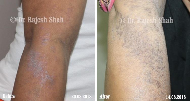 Lichen Planus Before and After Case Photo
